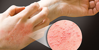 Overcome Latex Allergies: The Best Treatments to Get Relief!